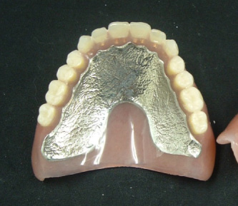 フェアリー加工義歯 写真1